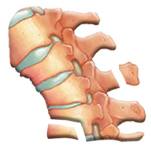 Avulsión vertebral